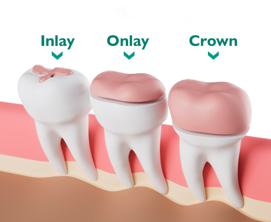 Inlays & Onlays – Walnut Creek Prosthodontics and Dental Implants