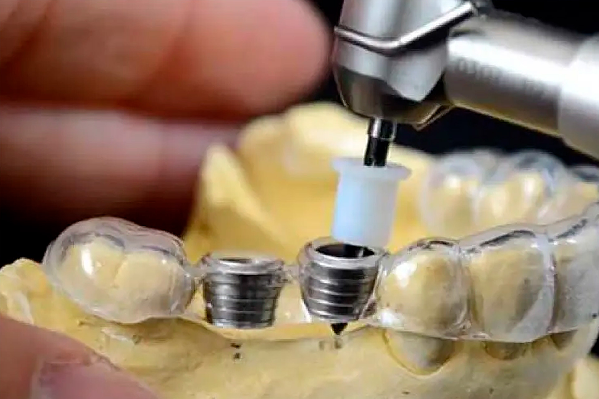 3D Guided Implant